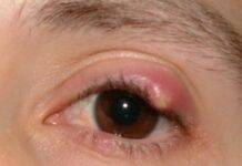 Флоксал при ячмене на верхнем веке — жизнь без болезней и лекарств — жизнь без болезней и лекарств