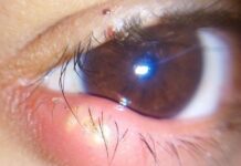 От чего появляется ячмень на глазу: причины возникновения у взрослых