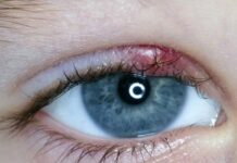 Можно ли с ячменем на глазу выходить на улицу и гулять