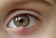 Что делать если ячмень прорвался: чем обработать