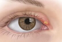 Сонник Ячмень на Глазу видеть во сне к чему снится?