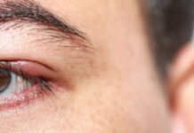 Можно ли носить линзы при ячмене и что это за болезнь?