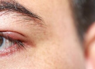 Можно ли носить линзы при ячмене и что это за болезнь?