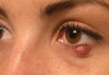 К чему снится ячмень (на веке)? Сонник Ячмень (на веке): Толкование снов онлайн на Сонариум