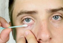 Как вылечить ячмень на глазу йодом