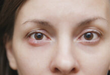 Ячмень на глазу: как быстро лечить дома, как вылечить ячмень на глазу у ребенка, причины появления.