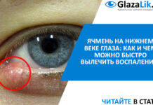 Ячмень на нижнем веке глаза: как и чем быстро вылечить воспаление