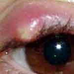 Ячмень на глазу, причины, симптомы, лечение. Все о глазных болезнях на портале vseozreni.