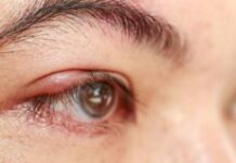 Шишка на глазу после ячменя