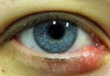 Что делать если ячмень на глазу не проходит две недели?