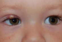 Ячмень на глазу у ребенка — что делать и чем лечить