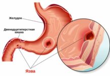 Язва желудка: причины, симптомы и лечение в статье хирурга Нижегородцев А. С.