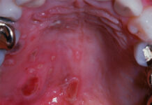 Язвочки на нёбе во рту — фото, причины и лечение