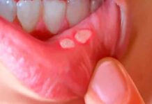 Язвочки во рту. Откуда берутся язвочки во рту? Лечение язвочек во рту