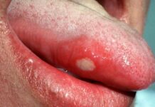 Язвы на языке. Основные причины появления язв на языке