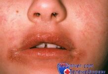 Как спасти свои губы? Борьба с заедами и воспалением каймы губ