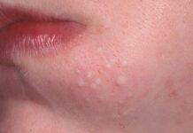 Скажите «НЕТ! » комедонам: уход за проблемной кожей