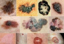 Злокачественные новообразования кожи: причины, симптомы и лечение в статье онколога Лисовой В. А.