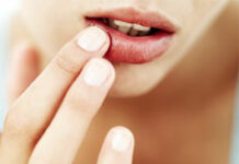 Герпес: как предотвратить неприятный сюрприз?