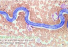 Дирофиляриоз: симптомы, подкожный и внутренний дирофиляриоз у человека, лечение и профилактика