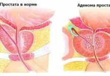 Аденома простаты — опухоль в области предстательной железы.