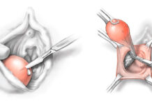Как лечить бартолинит на половых губах у женщин в Москве. Что это? Симптомы и последствия болезни