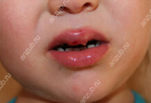 Обзор лучших мазей, которые помогут при стоматите у ребенка