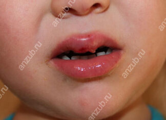 Обзор лучших мазей, которые помогут при стоматите у ребенка