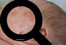 Розеола У детей: Причины, Симптомы И Лечение