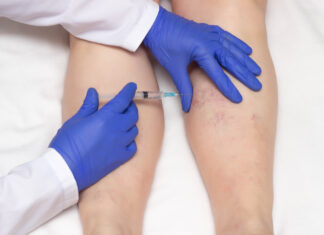 Как избавиться от варикоза на ногах