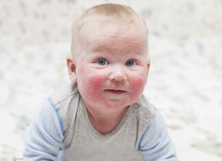 Все про атопический дерматит