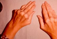 Чем характеризуется артрит пальцев рук?