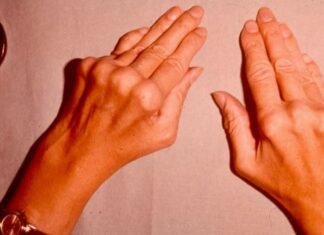 Чем характеризуется артрит пальцев рук?