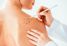 Меланома: отчего она появляется, какие процессы в ДНК ее сопровождают и как отличить меланому от родинки