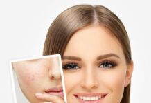 Постакне — симптомы и лечение