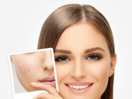 Постакне — симптомы и лечение