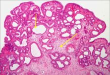 Карциноидная опухоль – симптомы, диагностика, лечение