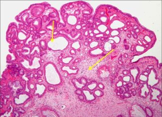 Карциноидная опухоль – симптомы, диагностика, лечение