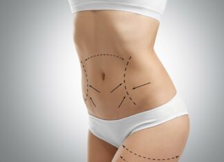 Абдоминопластика: реабилитация