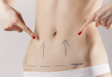 Подтяжка живота нитями