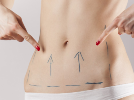 Подтяжка живота нитями