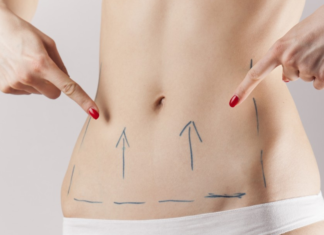 Подтяжка живота нитями