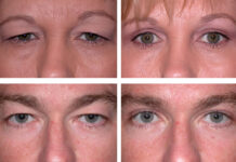 Ответы пластического хирурга по блефаропластике