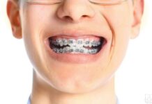 Как выбрать брекеты для детей