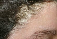 Псориаз – как лечить кожные заболевания, причины и симптомы