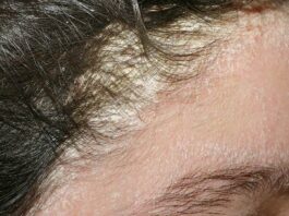 Псориаз – как лечить кожные заболевания, причины и симптомы