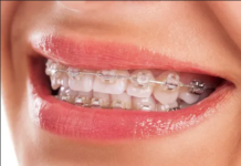 Особенности невидимых брекетов