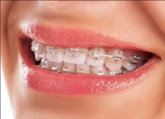 Особенности невидимых брекетов