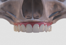 Особенности имплантации зубов