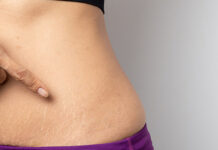 Лазерное удаление растяжек и стрий: особенности и преимущества процедуры